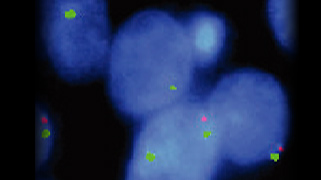 Vysis-PTEN-_-CEP-10-FISH-Probe_AbnormalHybridization.