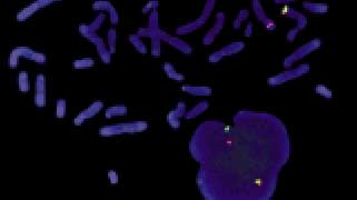 Vysis-LSI-MLL-Dual-Color,-Break-Apart_AbnormalHybridization