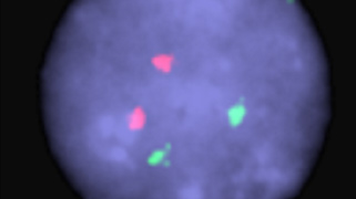 vysis-igh-ccnd1-df-fish-probe-kit-hybridization-abnormal