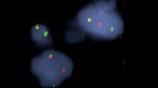 vysis-lsi-ddit3-12q13-hybridization-abnormal