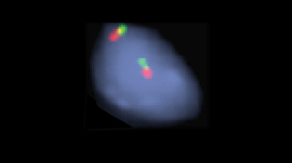 vysis-lsi-ddit3-12q13-hybridization-normal