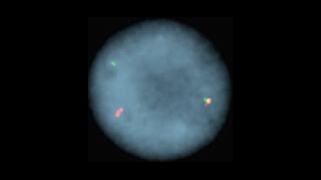 vysis-lsi-etv6-12p13-hybridization-abnormal