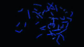 Vysis-LSI-D13S319-(13q14.3)-SpectrumOrange-Probe_AbnormalHybridization