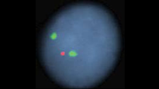 vysis-d13s319-13q34-hybridization-abnormal