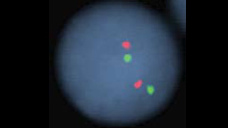 vysis-d13s319-13q34-hybridization-normal