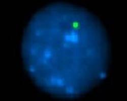 vysis-lsi-13q34-spectrumgreen-hybridization-abnormal