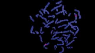 vysis-lsi-d13s25-13q14.3-hybridization-normal