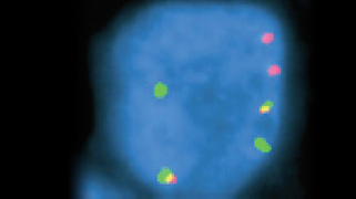 vysis-lsi-foxo1-13q14-hybridization-abnormal