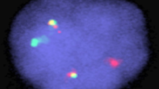 vysis-lsi-igh-ccnd1-xt-dual-color-dual-fusion-hybridization-abnormal