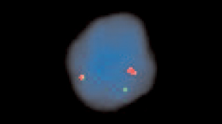 Vysis-FUS-Break-Apart-FISH-Probe-Kit_AbnormalHybridization