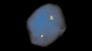 vysis-lsi-fus-16p11-hybridization-normal