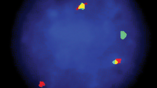 vysis-lsi-igh-maf-dual-color-dual-fusion-hybridization-abnorma