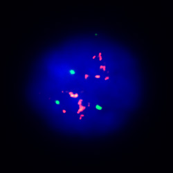 pathvysion-her-2-dna-probe-kit-II-hybridization-abnormal