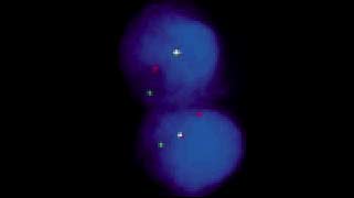 vysis-lsi-rara-dual-color-break-apart-rearrangement-probe-hybridization-abnormal