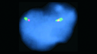 Vysis-LSI-BCL2-Break-Apart-FISH-Probe-kit_NormalHybridization