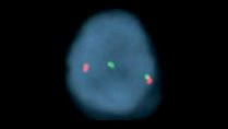 Vysis-LSI-BCL2-Break-Apart-Hybridization-Abnormal