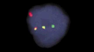 vysis-lsi-igh-bcl2-dual-color-dual-fusion-translocation-probe-kit-hybridization-abnormal