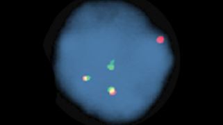 vysis-lsi-igh-malt1-dual-color-dual-fusion-hybridization-abnormal