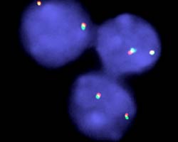 vysis-lsi-malt1-dual-color-break-apart-rearrangement-probe-hybridization-normal