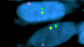 vysis-lsi-ss18-18q11.2-hybridization-abnormal