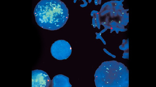 vysis-lsi-n-myc-cep2-hybridization_abnormal