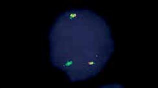Vysis-LSI-ETV6-RUNX1-DC-DF-Hybridization-Image2