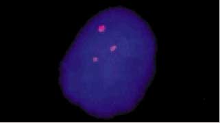 vysis-lsi-21-21q22.13-22.-hybridization-abnormal