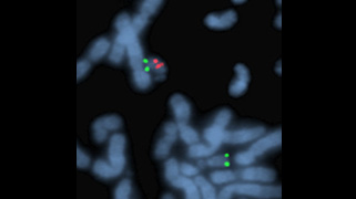 vysis-digeorge-region-probe-lsi-tuple1-hira-spectrumorange-telvysion-22q-spectrumgreen-hybridization-abnormal