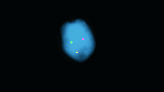 Vysis-LSI-BCL6-(ABR)-Dual-Color-Break-Apart-Rearrangement-Probe_Abnormal