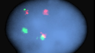 vysis-lsi-igh-fgfr3-dual-color-dual-fusion-hybridization-abnormal