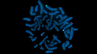 vysis-lsi-nsd1-5q35-hybridization-abnormal