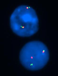 vysis-pdgfrb-break-apart-fish-probe-kit-hybridization-abnormal