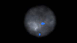 vysis-lsi-myb-hybridization-normal.