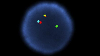 Vysis-BCR_ABL1_ASS1-Tri-Color-DF-FISH-Probe_AbnormalHybridization