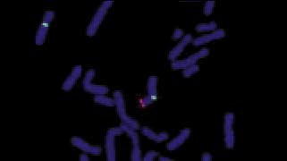 vysis-kallman-region-probe-lsi-kal-spectrumorange-vysis-cep-x-spectrumgreen-hybridization-normal