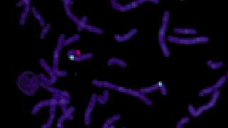 Vysis-SRY-Probe-LSI-SRY-Spectrum-Orange_Vysis-CEP-X-Spectrum-Green_AbnormalHybridization